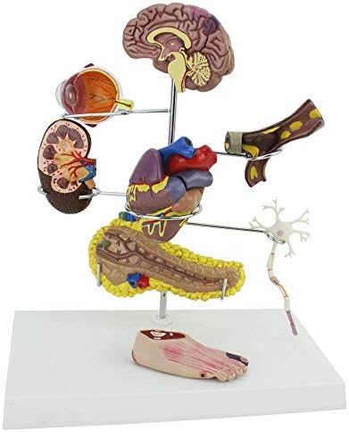 Model podučavanja, model anatomije, ljudska anatomija - Model patološkog dijabetesa Anatomski model dijabetičkih organa,